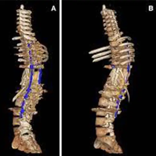 CT Dorsal Lumbar Spine with 3D Reconstruction